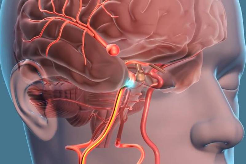 Cerebrovascular Surgery in Sinhagad Road, Swargate & Parvati Pune