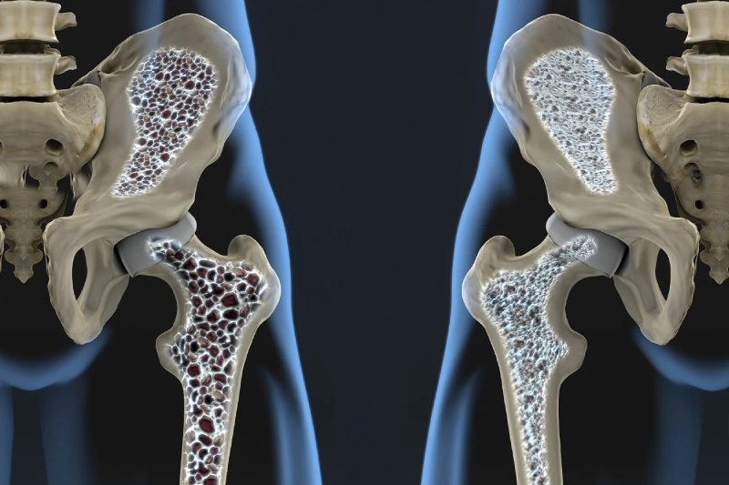 Osteoporosis Treatment Swargate, Sinhagad Road & Parvati Pune