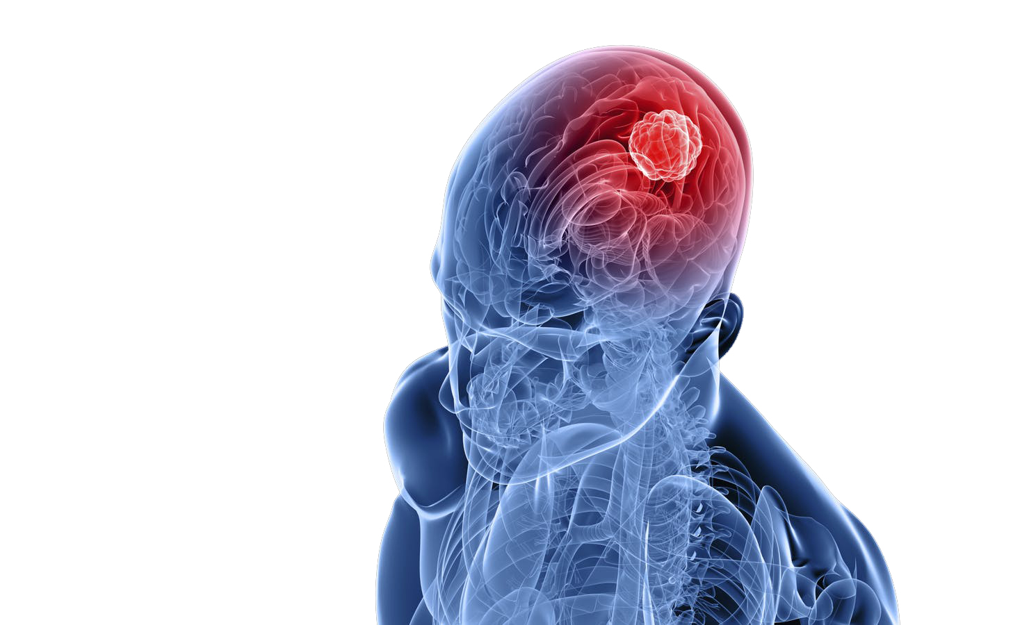 Brain Tumors treatment at Borde Clinic in Swargate, Sinhagad Road & Parvati Pune