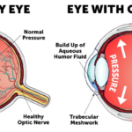 glaucoma specialist in pune