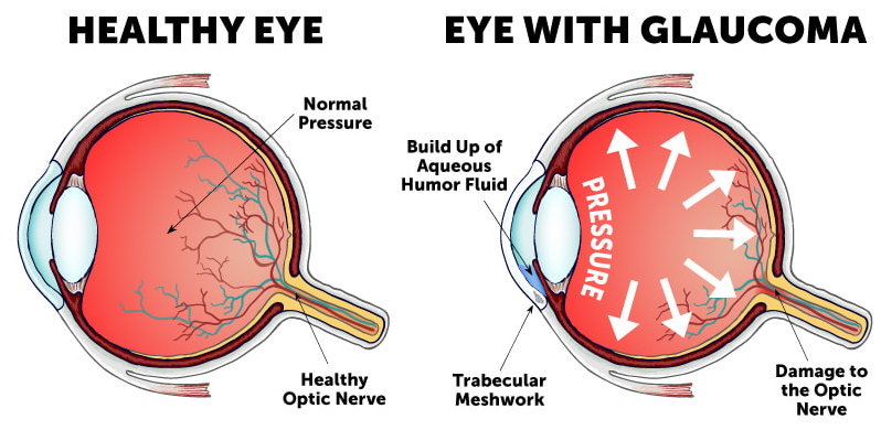 Eyes on Alert: Recognizing the Early Signs and Symptoms of Glaucoma