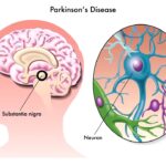 Parkinson's Disease Surgery in Swargate, Sinhagad Road & Parvati Pune