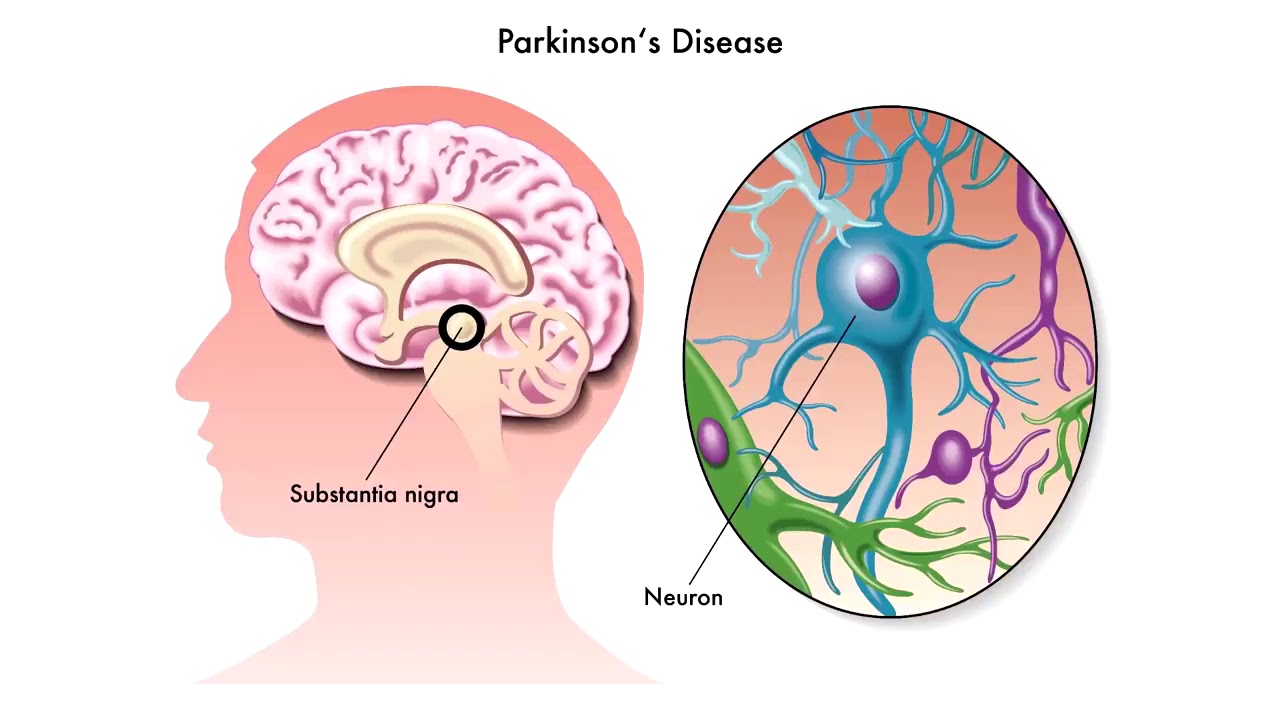 Parkinson's Disease Surgery in Swargate, Sinhagad Road & Parvati Pune