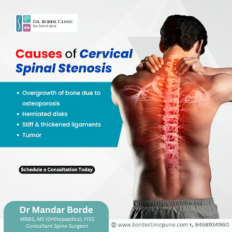 Causes of Cervical Spinal Stenosis (Cervical Spondylosis)